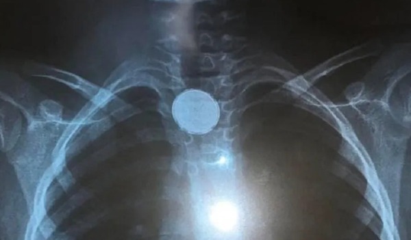 Diario HOY | Bebé que tragó una pila salió de terapia, contra todo pronóstico