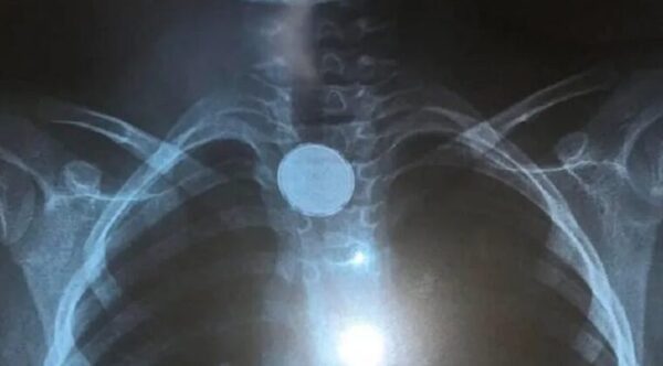 Bebé intoxicado por tragar una pila se salvó contra todo pronóstico