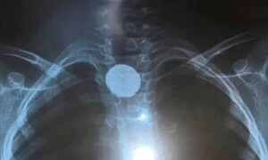 Bebé que tragó una pila salió de terapia – Prensa 5