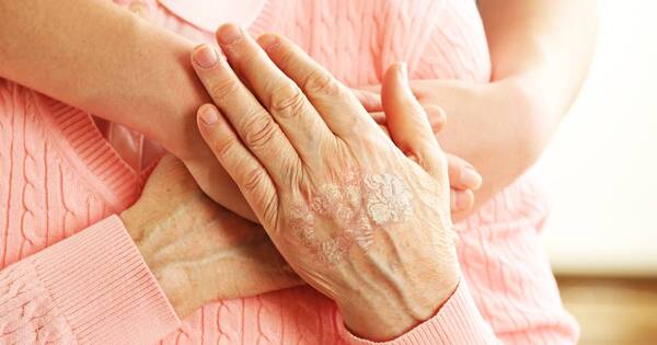 La Nación / Día Mundial de la Psoriasis: acceso a tratamiento correcto es clave para alcanzar remisión