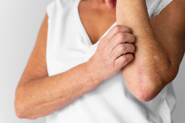 Día Mundial de la Psoriasis: el acceso al tratamiento correcto es la clave para alcanzar la remisión - El Independiente