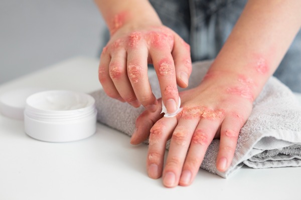 Diario HOY | Día Mundial de la Psoriasis: tratamiento correcto, clave para alcanzar la remisión