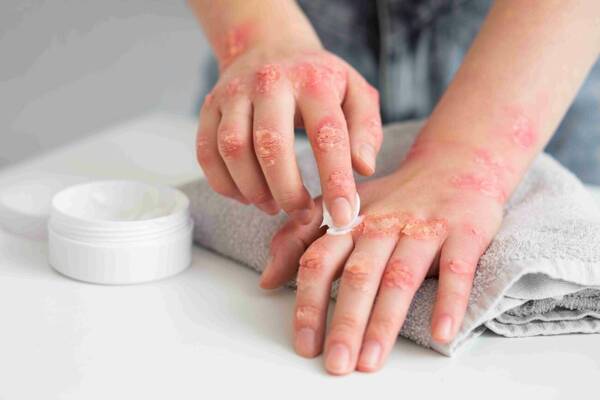 Día Mundial de la Psoriasis: el acceso al tratamiento correcto es la clave para alcanzar la remisión