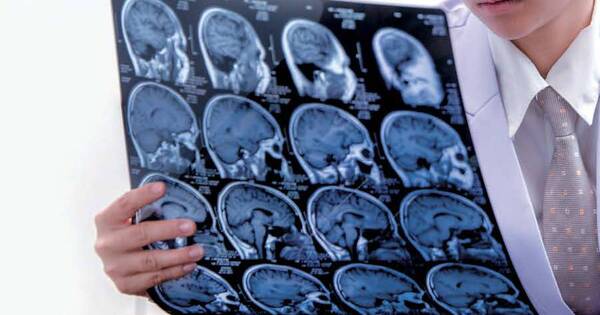 La Nación / Día Mundial del Ictus: cuando el tiempo = cerebro
