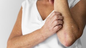 Acceso al tratamiento correcto es clave contra la psoriasis