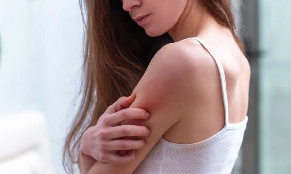 Buscando concienciar sobre la Psoriasis, invitan a una charla educativa - Unicanal