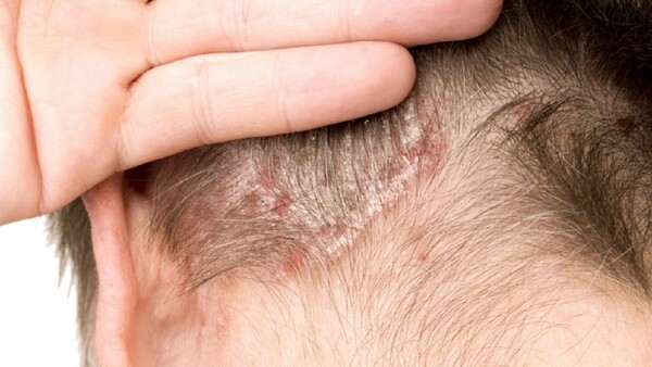 La psoriasis se puede tratar con fototerapia