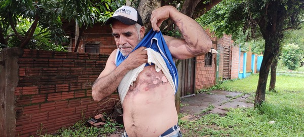 Hombre es atacado y quemado en Encarnación: ¿Una broma de mal gusto?