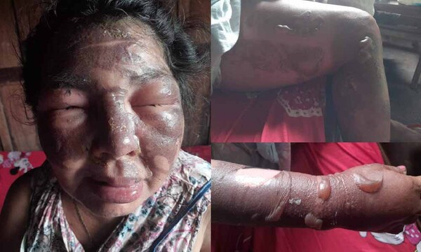 Piden ayuda para mujer discapacitada que se quemó con aceite hirviendo en Coronel Oviedo – Prensa 5
