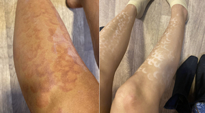 Diario HOY | Le quemaron ambas piernas durante depilación láser: "Fue una negligencia total"