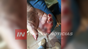 MUJER FUE ATACADA CON UN CUCHILLO QUE LE TRASPASÓ LA MANO - Itapúa Noticias