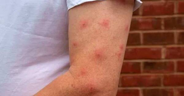 La Nación / Advierten sobre picaduras de insectos en los alérgicos