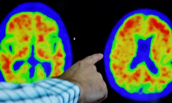 Descubren una proteína con efectos protectores contra el Alzheimer