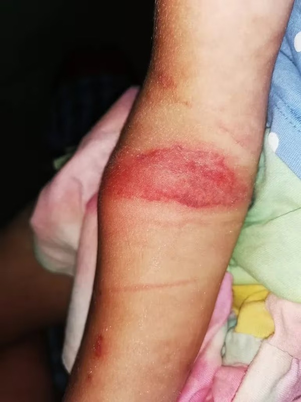 Niña casi pierde el brazo tras mala colocación de yeso en IPS, según denuncia