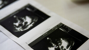 Diario HOY | Mujer con útero doble queda embarazada en ambos: un caso extremadamente raro