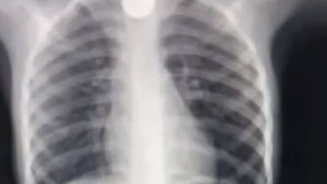 Niño traga una moneda y sufre toda una odisea para someterse a la cirugía