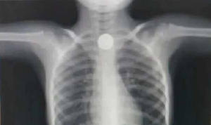 Niño tragó por accidente moneda de 500 guaraníes y será sometido a cirugía - Noticiero Paraguay