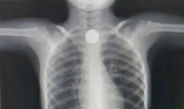Niño tragó por accidente moneda de 500 guaraníes y será sometido a cirugía - Noticiero Paraguay