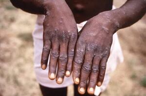 República Democrática del Congo registra número récord de casos de viruela símica en lo que va de año - Mundo - ABC Color