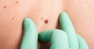 La Nación / Lanzan campaña para detectar cáncer de piel