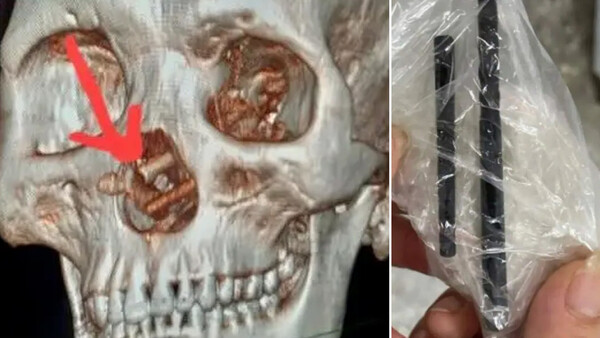 Diario HOY | Acudió al médico por un dolor: vivió con palillos en su cráneo durante 5 meses sin saberlo