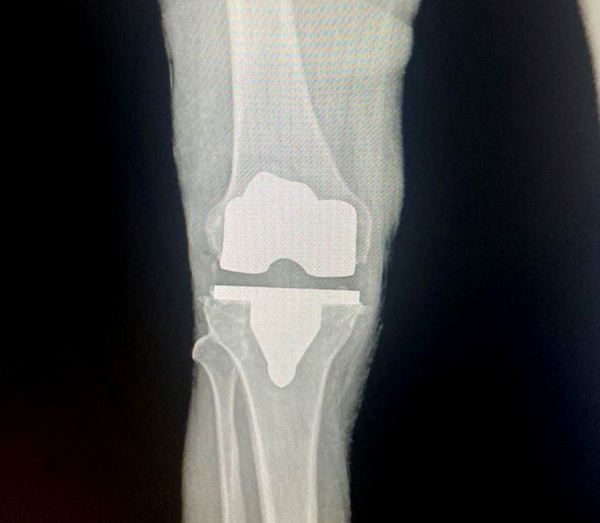 Exitosa cirugía de rodilla con Prótesis en el Hospital Distrital de Ñemby | OnLivePy