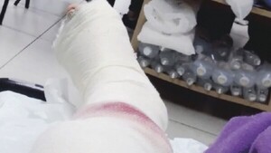 Pasajera se reventó la pierna en un accidente y culpa a motobolt
