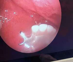 Tragó su prótesis dental y un médico recurrió a ingenioso método para extraerla - ABC en el Este - ABC Color