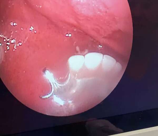 Tragó su prótesis dental y un médico recurrió a ingenioso método para extraerla - ABC en el Este - ABC Color