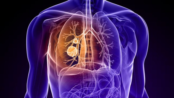Diario HOY | Los cinco tipos de cáncer silenciosos más difíciles de diagnosticar