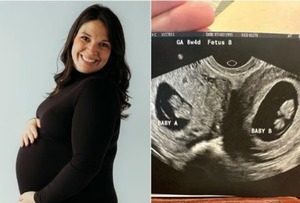 Mujer con dos úteros da a luz a mellizas en días diferentes