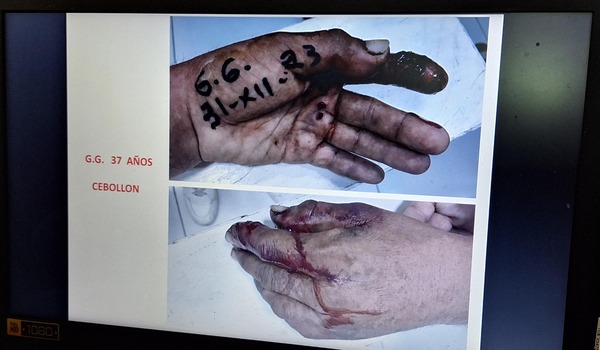 Artefacto pirotécnico desfiguró rostro a un niño y a otro la amputación del dedo índice | 1000 Noticias