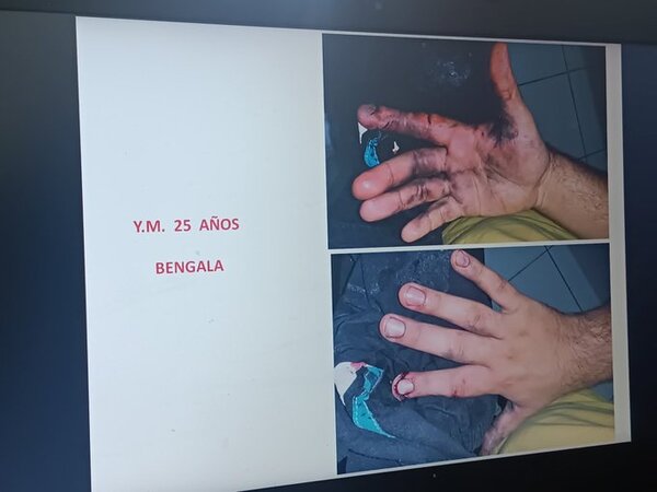 Varios desfigurados a causa de petardos en Año Nuevo