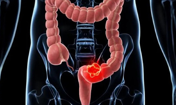 Vacuna muestra potencial frente a las recaídas de cáncer de páncreas y colon