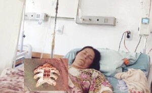 Picadura de un raro gusano deja grave a una mujer