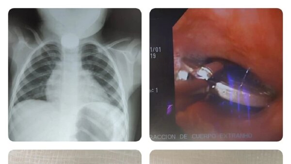 Médicos extraen con éxito una moneda tragada por un niño de 2 años en San Pedro - Radio Imperio 106.7 FM