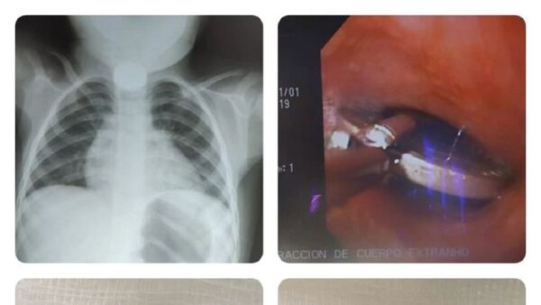 Médicos extraen con éxito una moneda tragada por un niño de 2 años en San Pedro