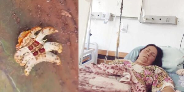 PICADURA DE GUSANO MANDÓ A TERAPIA INTENSIVA A SEÑORA - Itapúa Noticias