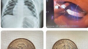 En Hospital de San Pedro, extraen una moneda de la garganta de un pequeño