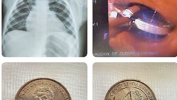 En Hospital de San Pedro, extraen una moneda de la garganta de un pequeño