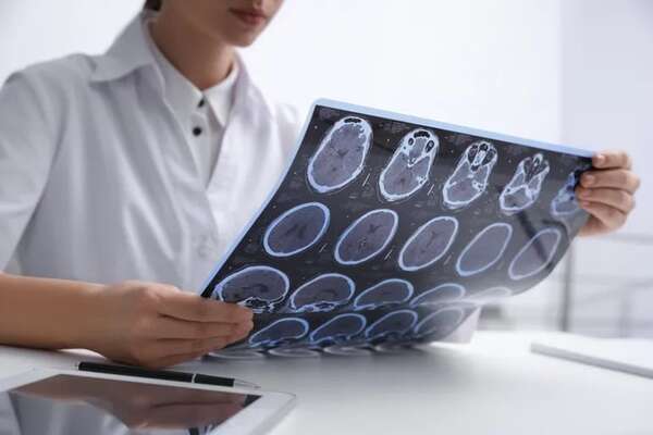 Revelan la función de una sinapsis cerebral que puede ser útil contra esclerosis y cáncer - Ciencia - ABC Color