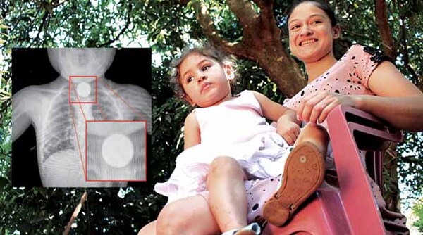 Fundación Tesãi con rápida asistencia salva vida de niña que “tragó” una moneda | DIARIO PRIMERA PLANA