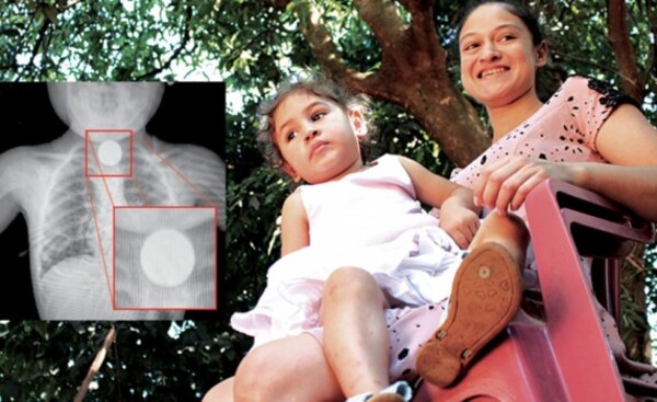 Niña de 2 años tragó moneda y debió ser operada