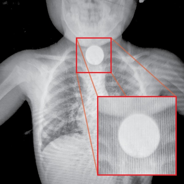 Niña que tragó una moneda se encuentra fuera de peligro - La Clave