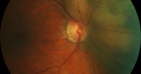 Diario HOY | Oncología Ocular: especialidad disponible en Clínicas