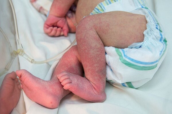 Desesperante: Aumentan los casos de dengue en niños - ADN Digital