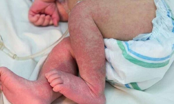 Desesperante: Aumentan los casos de dengue en niños – Prensa 5