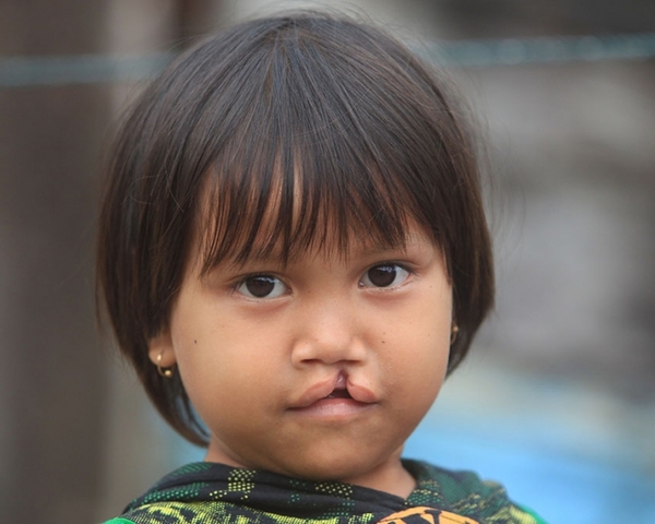 MÁS DE 13 MIL PERSONAS CON FISURA LABIO PALATINA EN PARAGUAY - La Voz del Norte