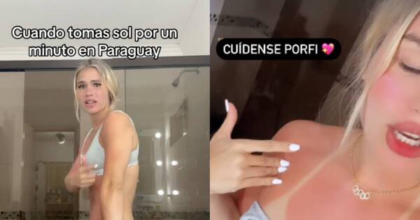 La Nación / ¿La belleza duele? Luana Alonso se quemó por culpa del bronceado