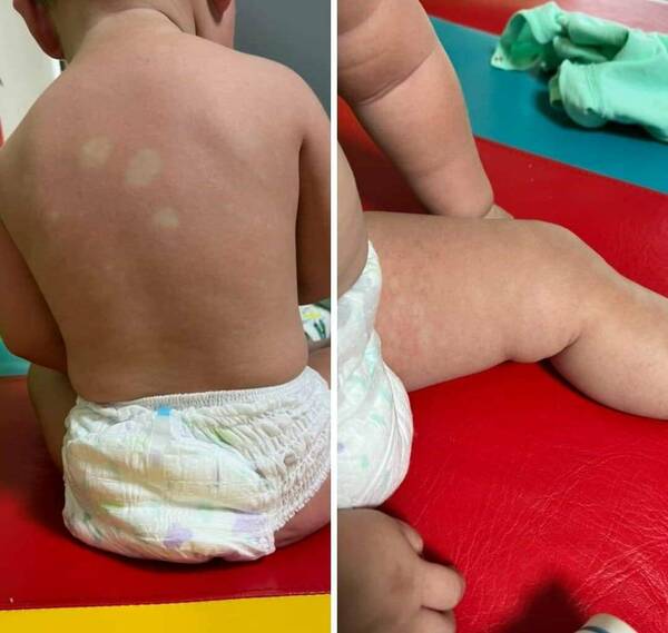Atenti para no confundir el dengue con otras afecciones en peques